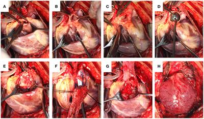 Clinical Application of Individualized Pulmonary Bi-Orifice for the Reconstruction of Right Ventricular Outflow Tract in Tetralogy of Fallot